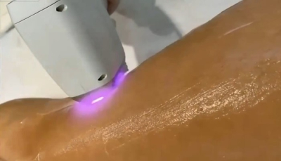 Agata Chorzepa mentre effettua un trattamento con il laser diodo